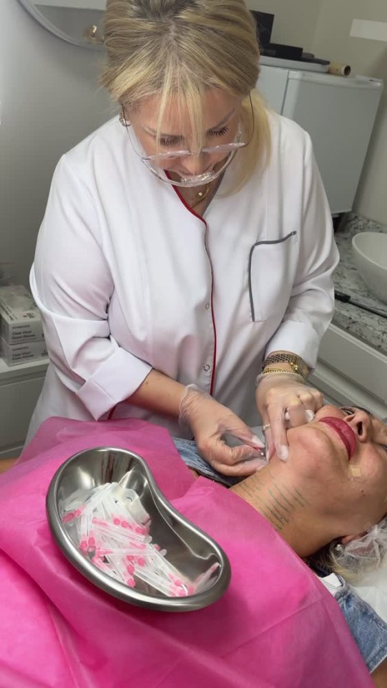 Non-surgical face and neck lifting with PDO threads